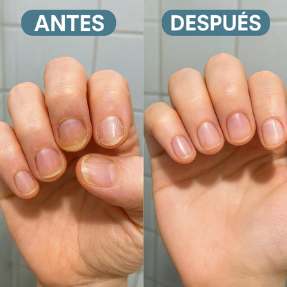 Aceite Natural MycoStop™ – Uñas listas para playa y piscina: elimina hongos desde la raíz y borra el amarillo (Con remedios naturales + Envío GRATIS)